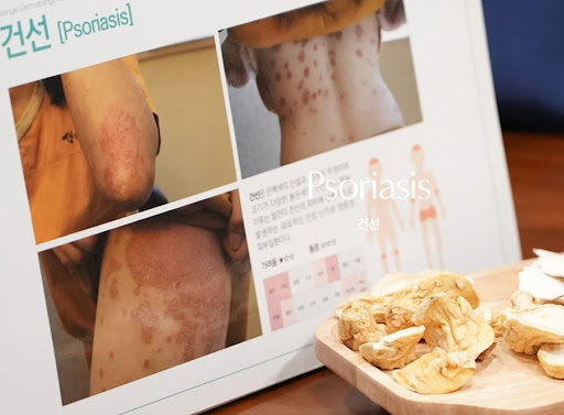 생기한의원으로 알아보는 건선 증상이 반복될 때 생활 확인 사항